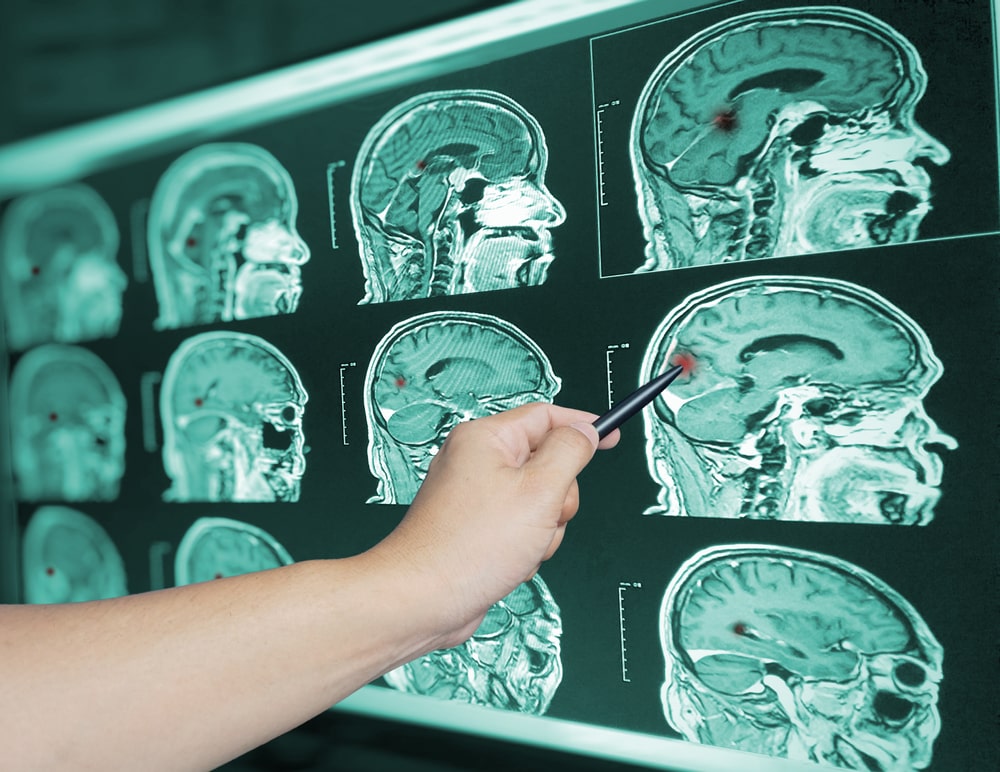 Person Pointing At A Red Dot On Brain X-Ray Scan