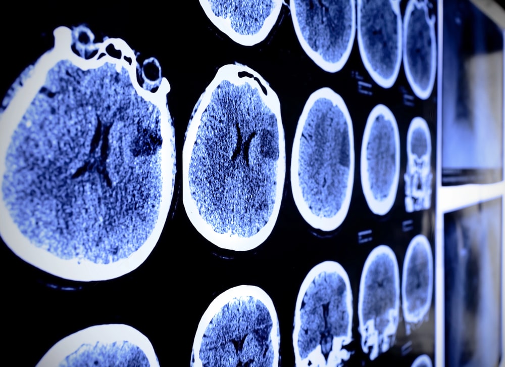 brain injury lawyer in Towson, Maryland
